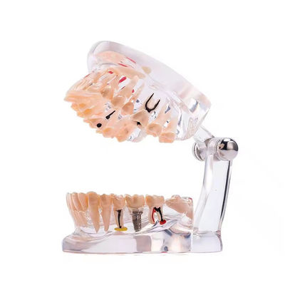 نموذج أسنان كامل الفم بـ 32 سنًا لمرض الزرع بتصميم واضح - نموذج أمراض الأسنان